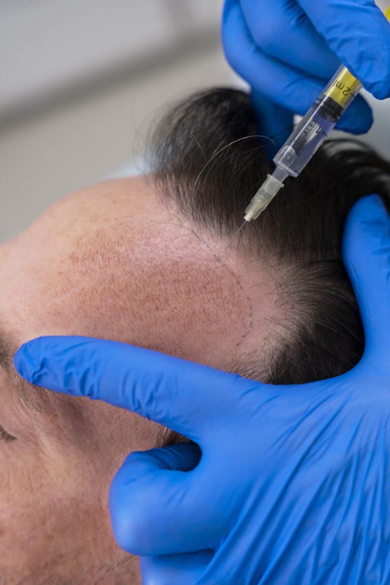 A gloved provider injects plasma from a syringe along a man's receding hairline