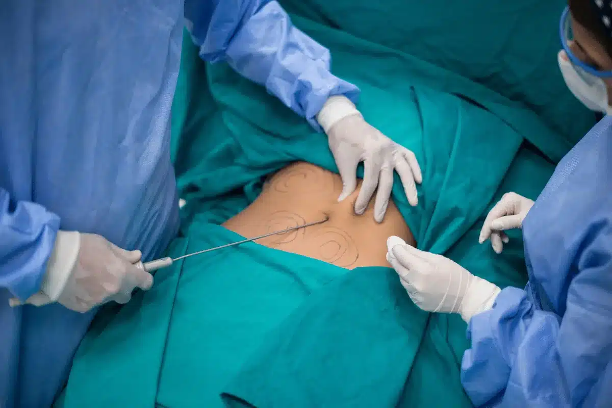 Adipose harvest: a gloved clinician guides a cannula into the draped, marked abdomen while an assistant holds gauze